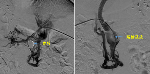 血栓攔路，如何破局——罕見巨大門靜脈血栓TIPS手術(shù)實錄