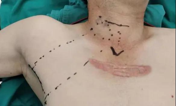 術(shù)后傷口可以“隱身”嗎？