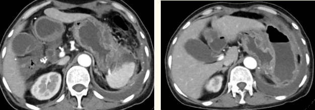 七年頑疾一朝除 消化外科二病區(qū)為患者切除胃巨大間質瘤