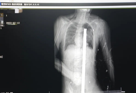 1.2米長的鋼筋貫穿男子胸腹！情況極度危險......