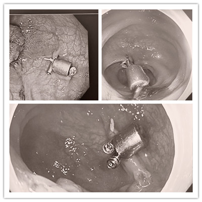 消化病醫(yī)院內(nèi)外科聯(lián)合開展3例“磁環(huán)預(yù)標(biāo)記輔助腹腔鏡結(jié)、直腸癌根治術(shù)”