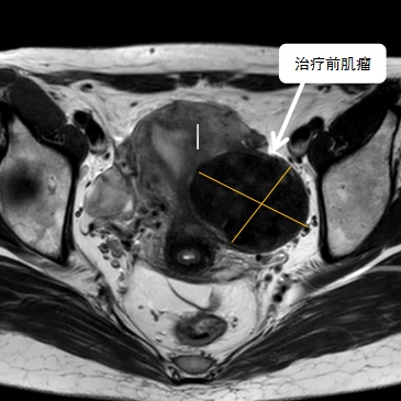 保子宮、保留生育功能—磁波刀治療子宮肌瘤
