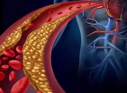 警惕！冠脈支架術(shù)后這些誤區(qū)千萬別踩，趕緊收藏！