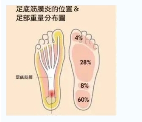 每年新生數(shù)百萬足底筋膜炎患者！國際醫(yī)學(xué)專家提醒：跑步要選擇合適的鞋