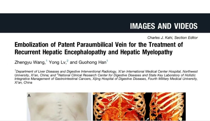 我院護理團隊臨床成果登榜國際肝病權(quán)威期刊，影響因子11.6